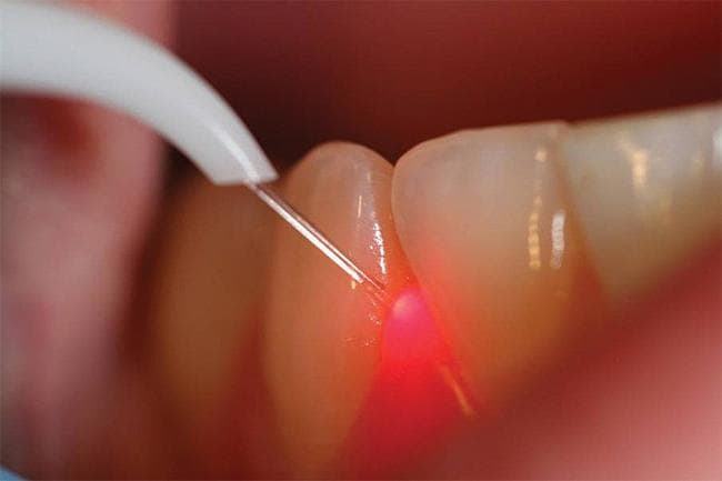 Как вылечить кисту зуба без удаления