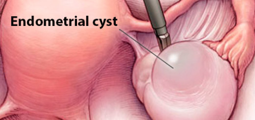 Как вылечить эндометриоидные кисты левого яичника thumbnail