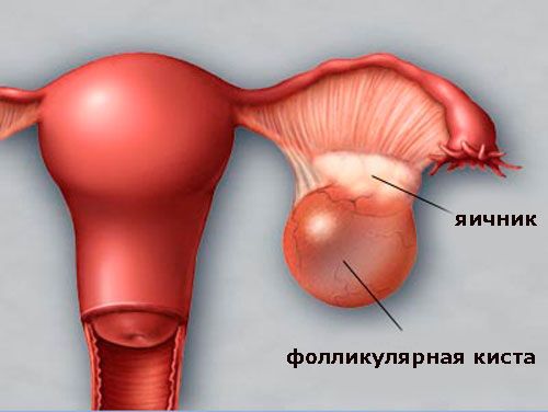 Киста левого яичника фолликулярная беременность